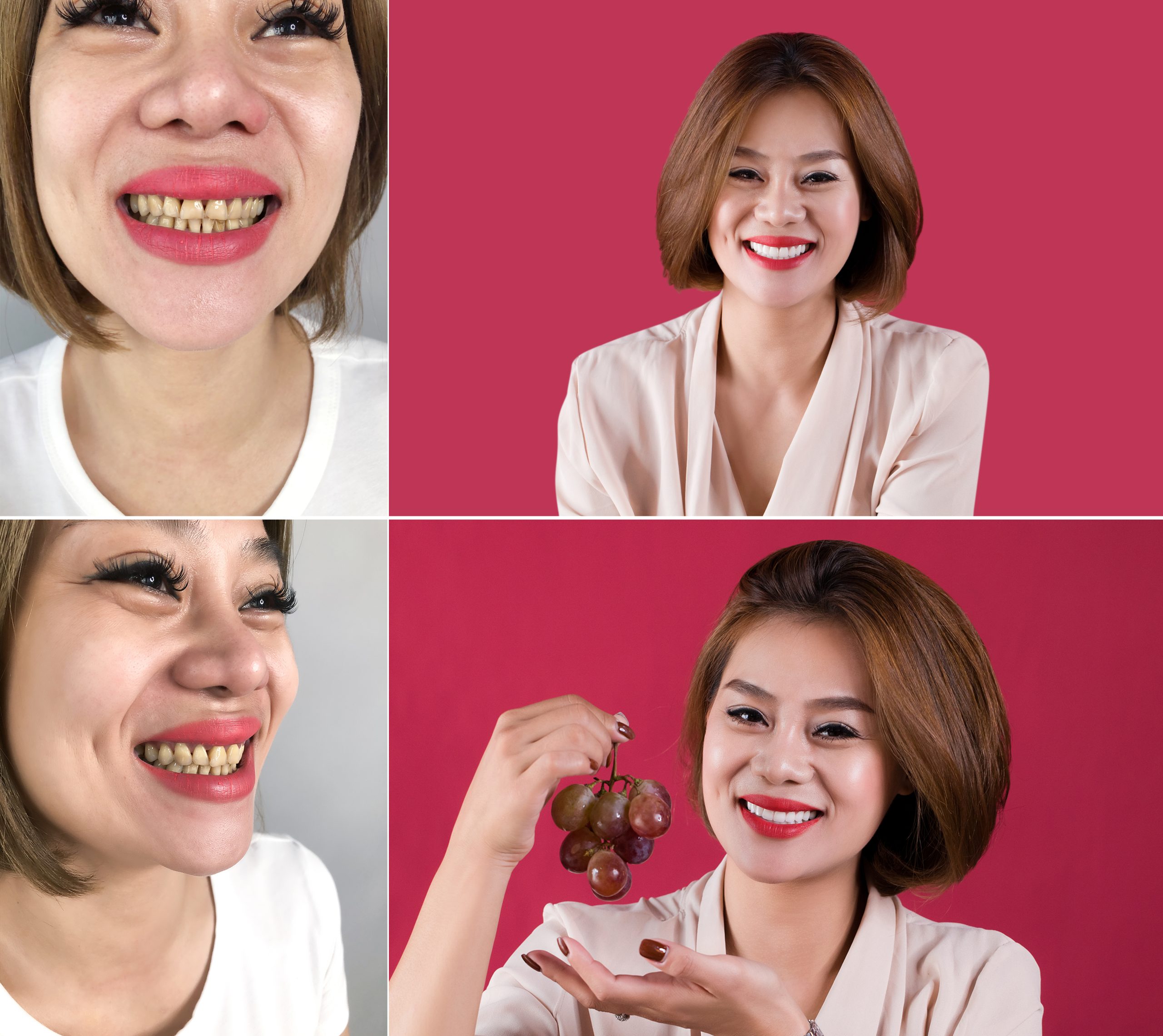 Review - Chị Dương Thuỳ Linh | Nha khoa Smile Up