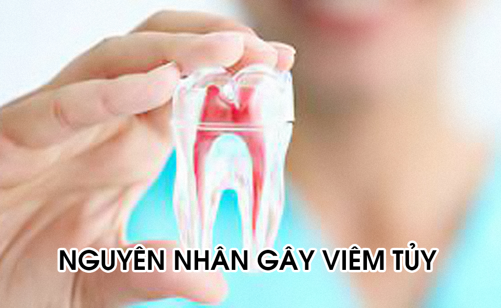 Viêm Tủy Răng | Nha khoa Smile Up