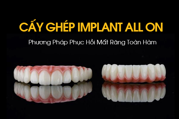 Cấy Ghép Implant All On