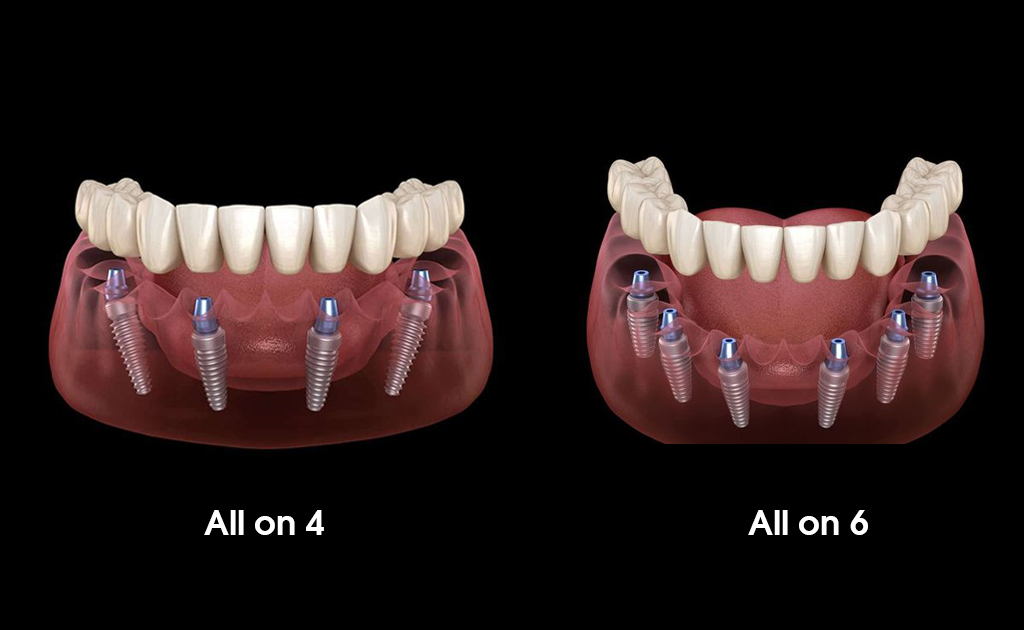 Cấy Ghép Implant All On