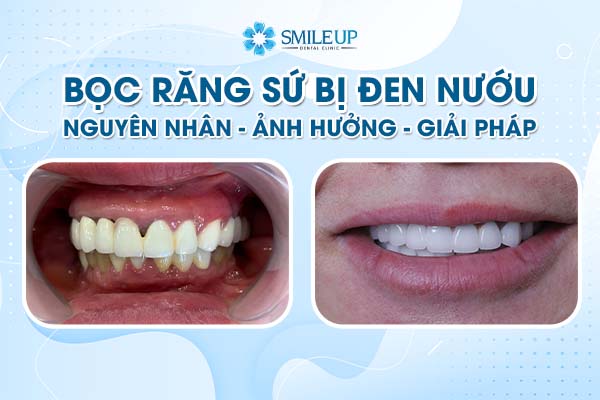 Bọc Răng Sứ Bị Đen Nướu