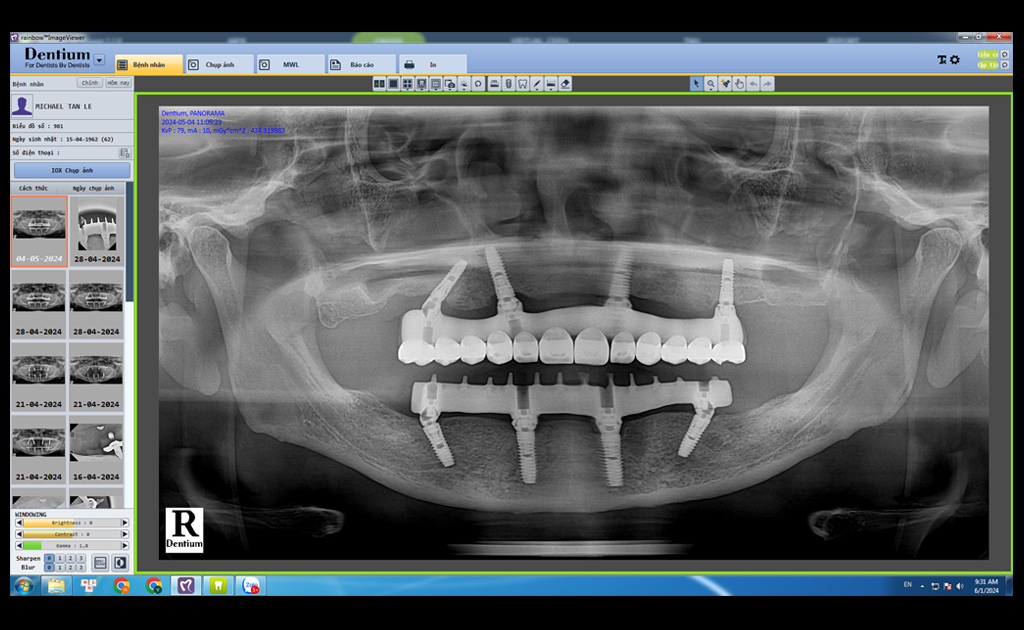 Cấy Ghép Implant All On