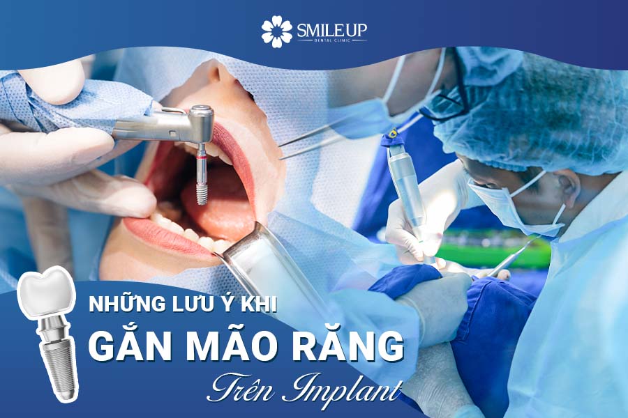 LƯU Ý SAU KHI GẮN MÃO RĂNG TRÊN IMPLANT