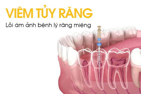 Viêm Tủy Răng