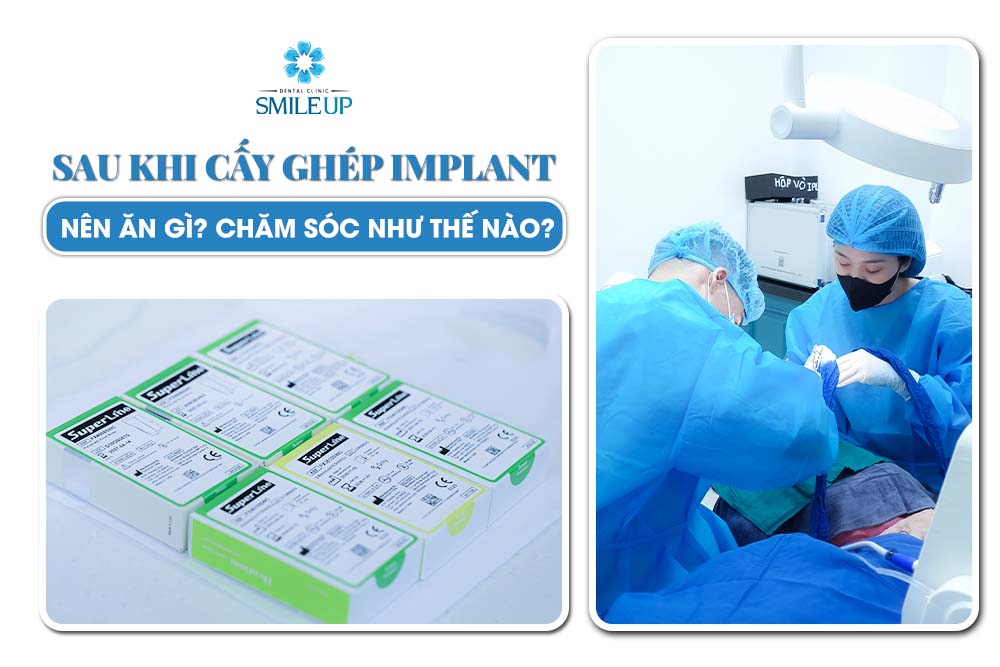 Sau Khi Phẫu Thuật Cấy Ghép Implant