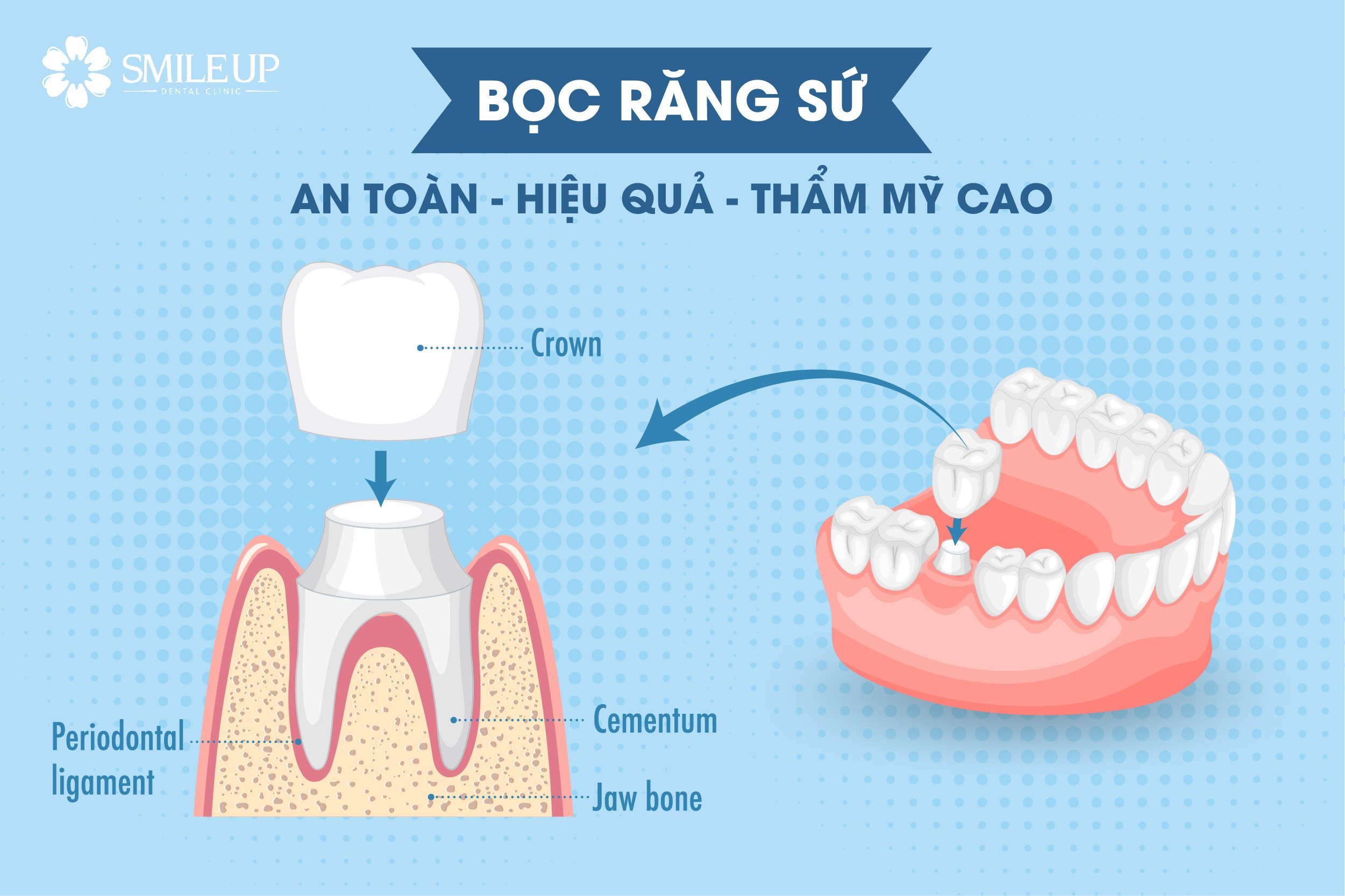 Bọc Răng Sứ