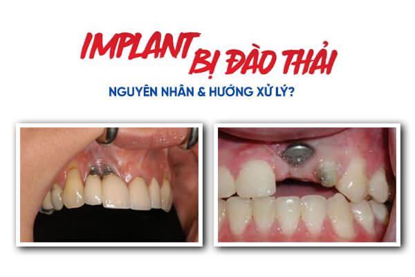 Implant Bị Đào Thải