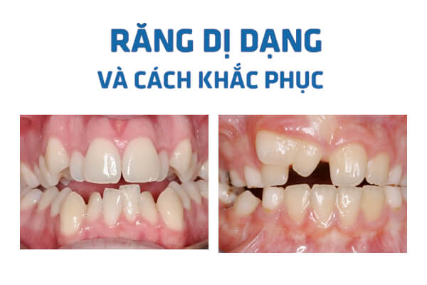 Răng Dị Dạng