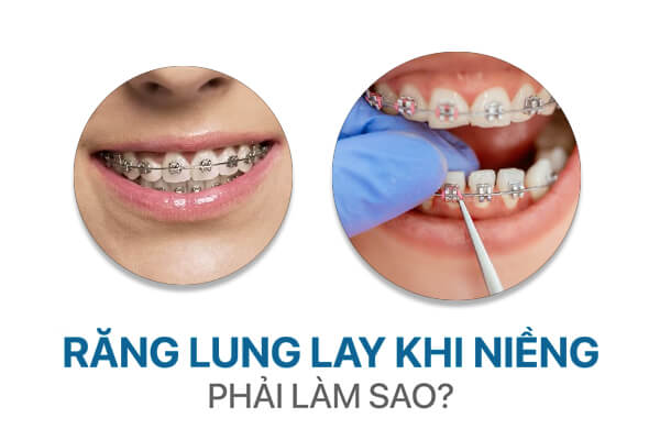 Răng Lung Lay Khi Niềng Răng