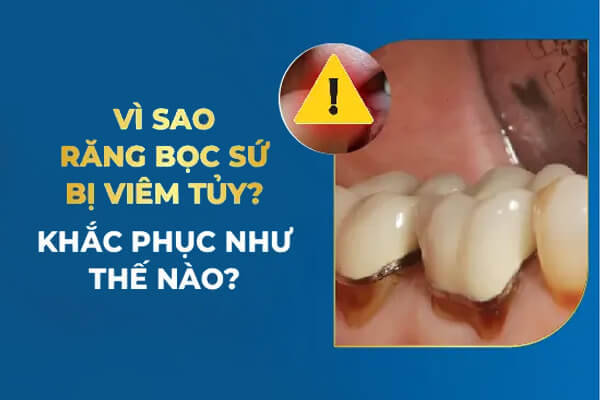 Bọc Răng Sứ Bị Viêm Tủy