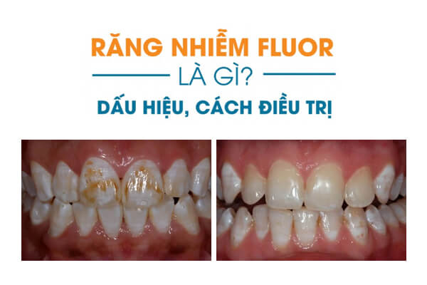 Răng Nhiễm Fluor là gì