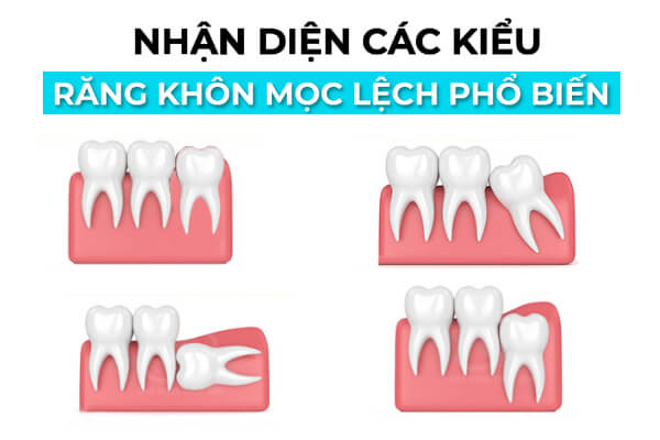 Các Kiểu Mọc Lệch Của Răng Khôn