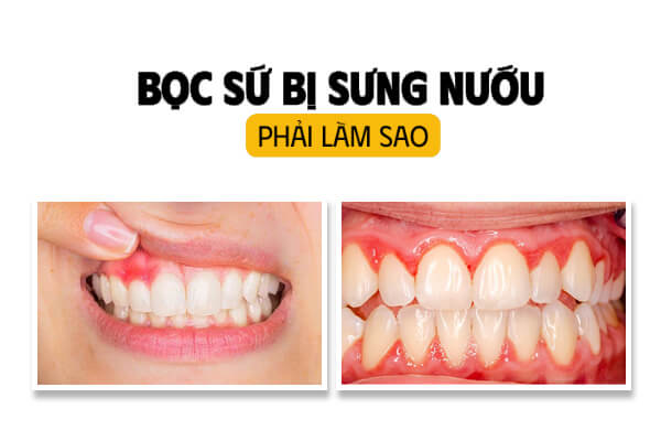 Bọc Răng Sứ Bị Sưng Nướu