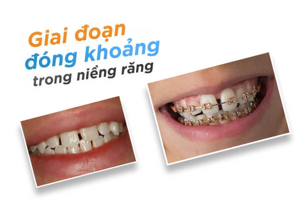 Giải Pháp Tối Ưu Cho Răng Thưa