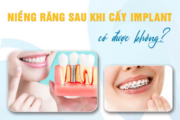 niềng răng sau khi cấy implant