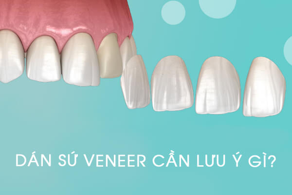 dán sứ veneer