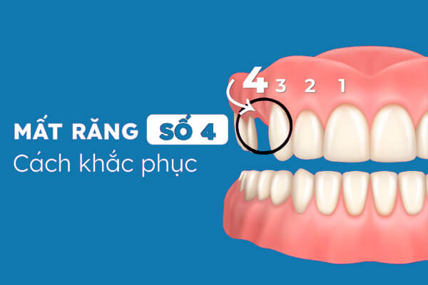 Mất răng số 4