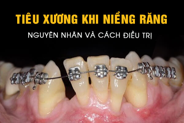 tiêu xương khi niềng răng