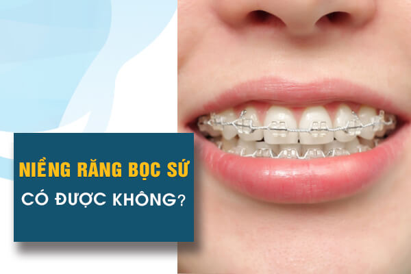 niềng răng bọc sứ