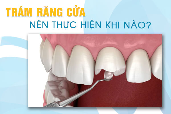 Trám răng cửa