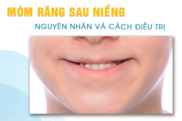 móm sau niềng răng