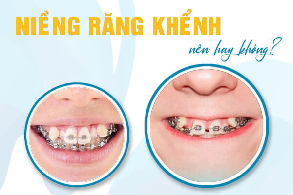 niềng răng khểnh