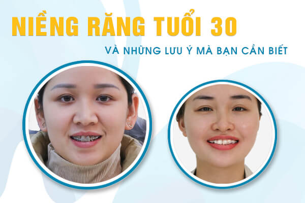 niềng răng tuổi 30