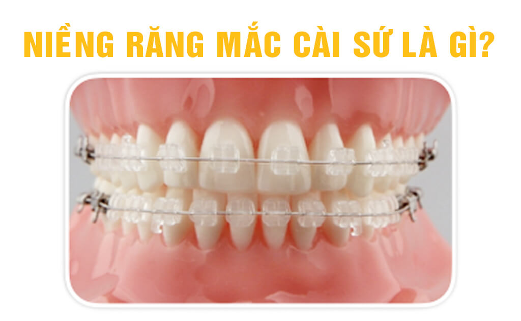 Niềng răng mắc cài sứ | Nha Khoa Smile Up