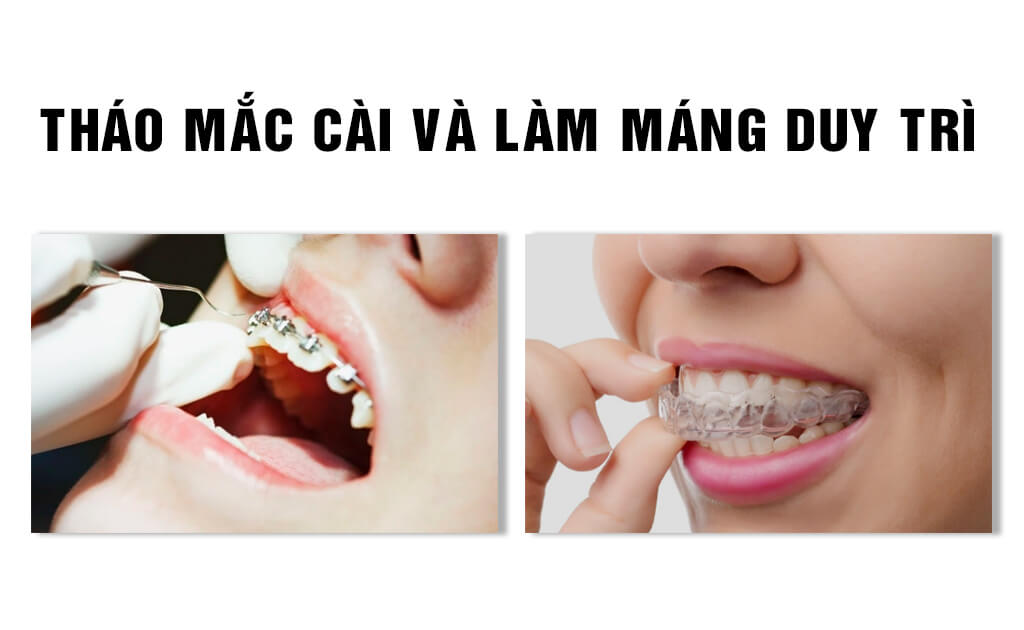 Niềng răng mắc cài sứ | Nha Khoa Smile Up