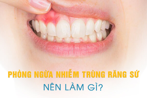 phòng ngừa nhiễm trùng răng sứ