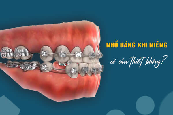 nhổ răng khi niềng