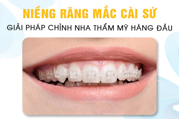 Niềng răng mắc cài sứ | Nha Khoa Smile Up