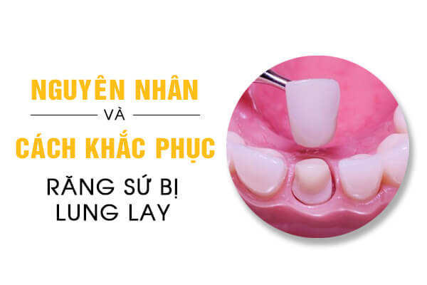 răng sứ bị lung lay