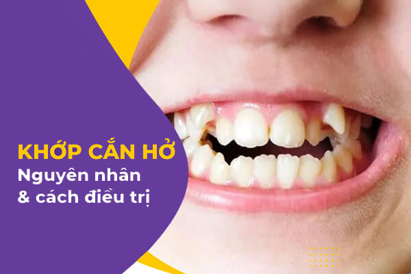 điều trị khớp cắn hở